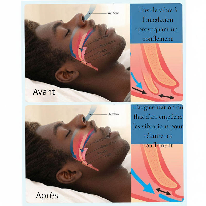 Clip Anti Ronflement